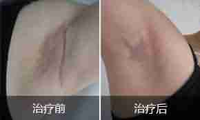 【揭秘】疤痕的症状类型有哪些-lni