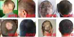 汉方毛囊激活生发疗法-lni