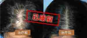 正规医生解析:脱发的症状表现-lni