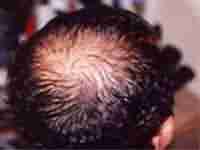 正规医生解析:脱发的症状表现-lni