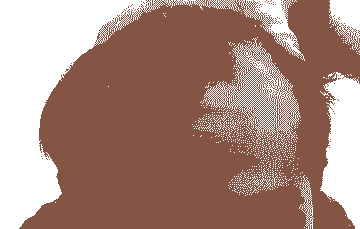 正规医生解析:脱发的症状表现-lni