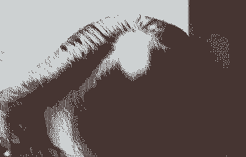 正规医生解析:脱发的症状表现-lni