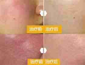 ������Ѫ˿ ѡ�����ݱ���-lni