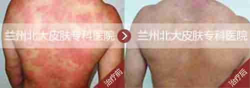 生物波止痒脱敏疗法 根治荨麻疹-lni