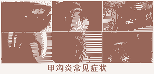 北大中西结合 科学治疗甲沟炎-lni