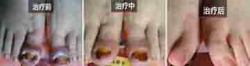 兰州治疗甲沟炎哪家医院好-lni