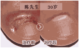 北大中西结合 科学治疗甲沟炎-lni