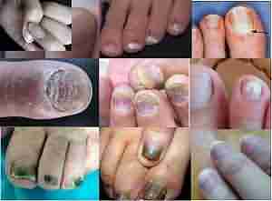 【揭秘】引起灰指甲的原因是什么-lni