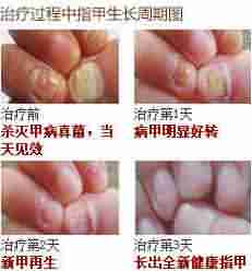 【揭秘】引起灰指甲的原因是什么-lni