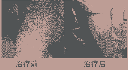 北大中西结合 解决鱼鳞病反复难题-lni