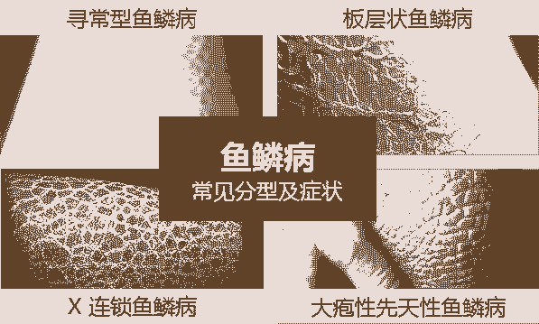 北大中西结合 解决鱼鳞病反复难题-lni