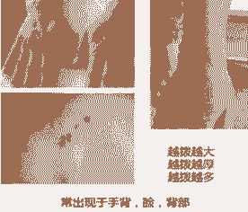 北大中西医结合综合疗法 专业治疗扁平疣-lni
