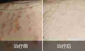 北大中西医结合综合疗法 专业治疗扁平疣-lni