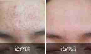 北大中西医结合综合疗法 专业治疗扁平疣-lni