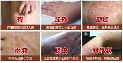 快速!北大中西结合 科学分型规范治慢性湿疹-lni