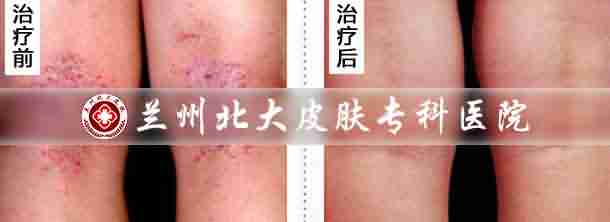 快速!北大中西结合 科学分型规范治慢性湿疹-lni