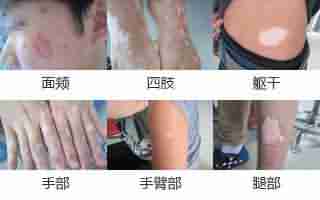 白斑是什么?有哪些症状表现?-lni