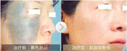 ����̥�Ƿ���Ҫ����?-lni