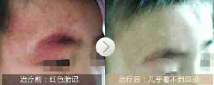 ����̥�Ƿ���Ҫ����?-lni