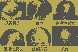 了解脱发治疗费用,不花冤枉钱-lni