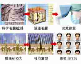 了解脱发治疗费用,不花冤枉钱-lni