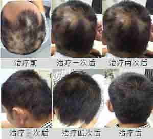 了解脱发治疗费用,不花冤枉钱-lni