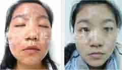 【青春痘】汉方光子清痘平衡疗法-lni