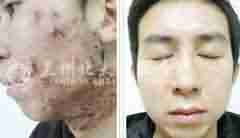 【青春痘】汉方光子清痘平衡疗法-lni