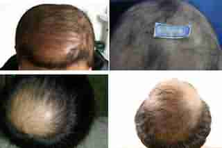 掉头发去医院挂哪个科-lni