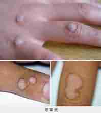 Ѱ�����֢״����Щ-lni