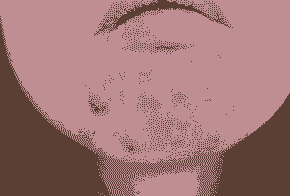 ֬Ƥ׵ľ֢״-lni