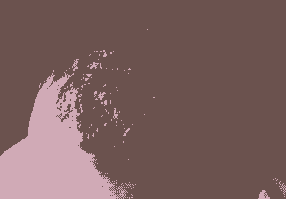 ֬Ƥ׵ľ֢״-lni