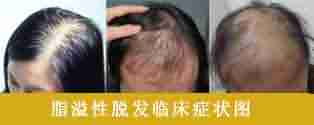 脂溢性脱发治疗方法是什么-lni