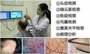 治疗脂溢性脱发-lni