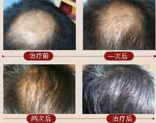 头发掉的很厉害是什么原因-lni