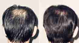 脂溢性脱发治疗方法是什么-lni