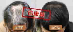 兰州治脱发首选兰州北大皮肤专科-lni