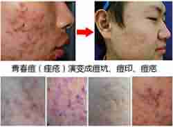 关于青春痘 这些你不得不知!-lni