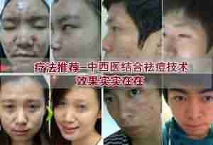 关于青春痘 这些你不得不知!-lni