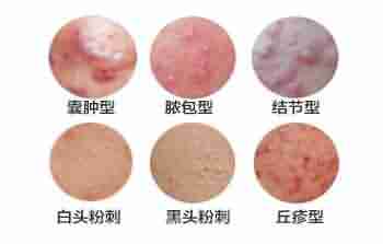 痤疮的临床表现有哪些-lni