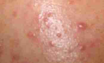 痤疮的临床表现有哪些-lni