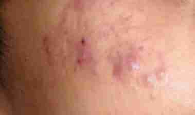 痤疮的临床表现有哪些-lni