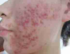 痤疮的危害有哪些?严重吗?-lni