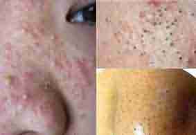 看粉刺省钱攻略,让你少花冤枉钱-lni