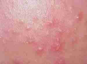 粉刺的危害有哪些-lni