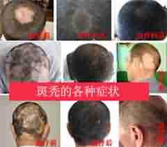 鬼剃头的症状主要有哪些-lni