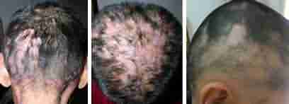 �������ƹ���ͷ�ķ����Ƕ���-lni