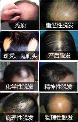 脱发知识 你不得不知-lni