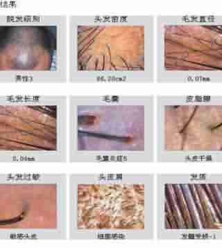 脱发知识 你不得不知-lni