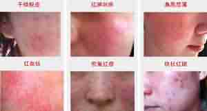 兰州治疗面部过敏医院哪家好-lni